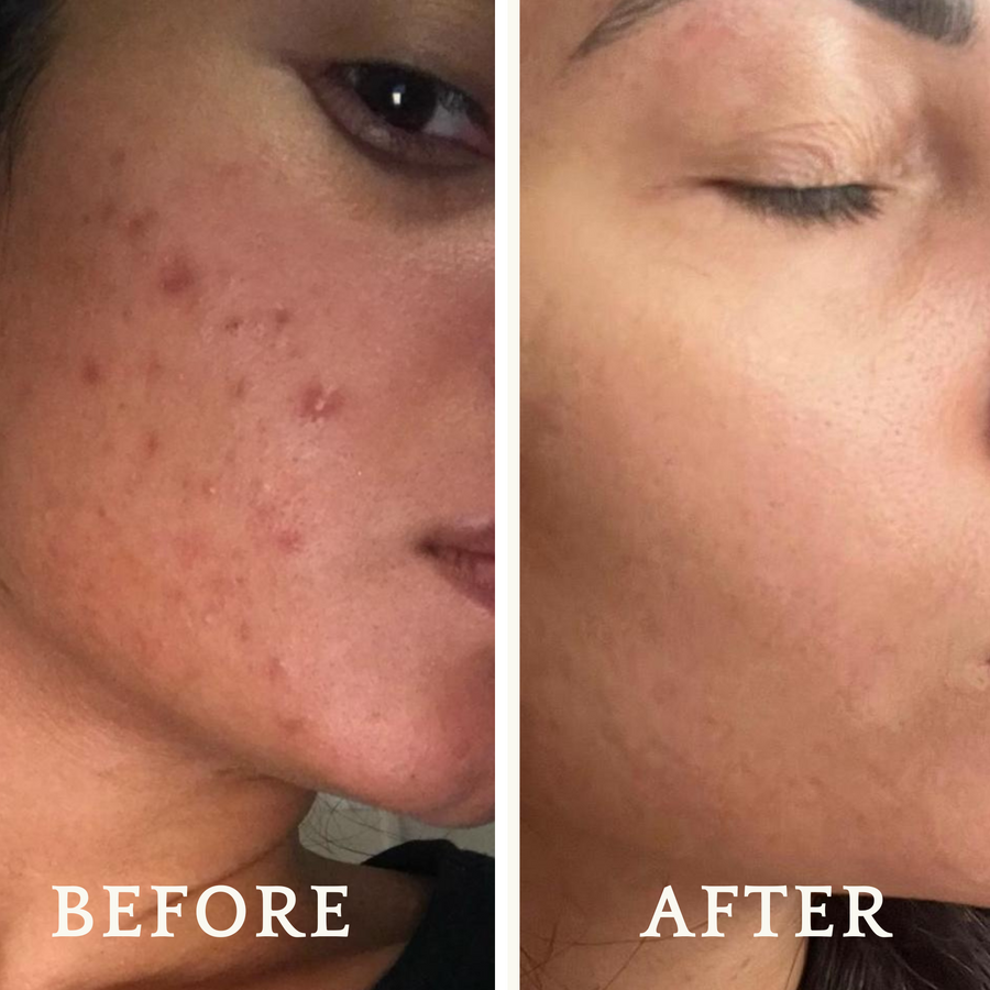 Black seed online oil for acne